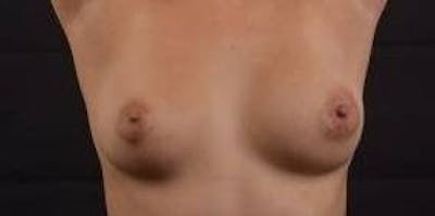 Aesthetic Breast Revision Before & After Gallery - Patient 172483 - Image 1