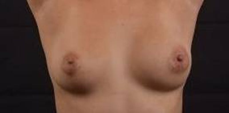 Aesthetic Breast Revision Before & After Gallery - Patient 172483 - Image 1