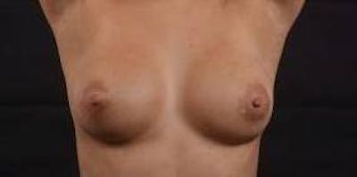 Aesthetic Breast Revision Before & After Gallery - Patient 172483 - Image 2