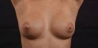 Aesthetic Breast Revision Before & After Gallery - Patient 172483 - Image 2