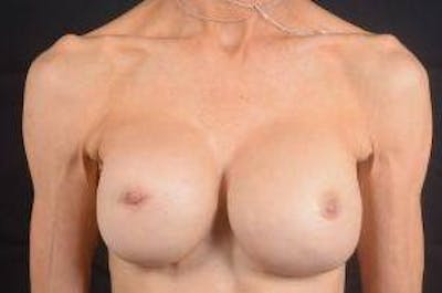 Aesthetic Breast Revision Before & After Gallery - Patient 300389 - Image 1