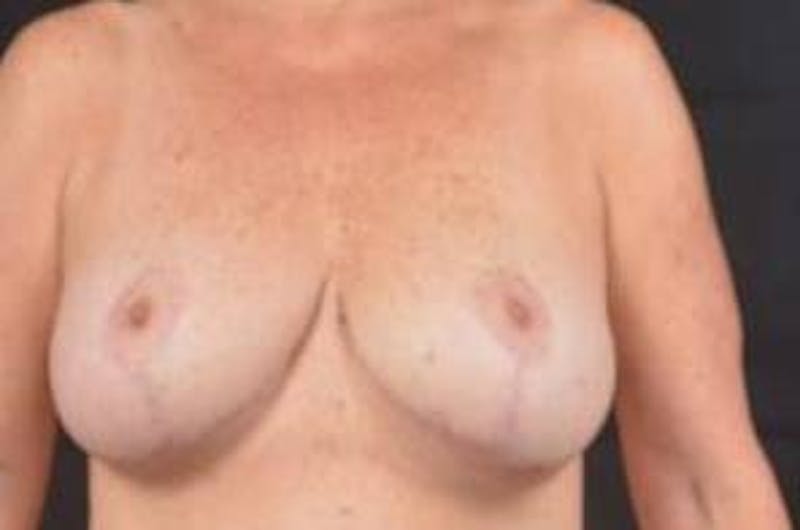 Aesthetic Breast Revision Before & After Gallery - Patient 803318 - Image 1