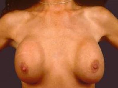 Aesthetic Breast Revision Before & After Gallery - Patient 419958 - Image 1