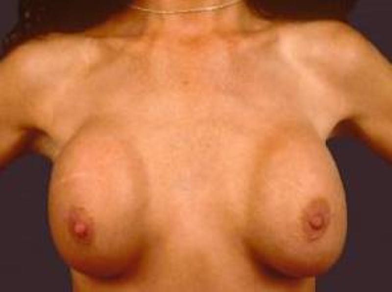 Aesthetic Breast Revision Before & After Gallery - Patient 419958 - Image 1