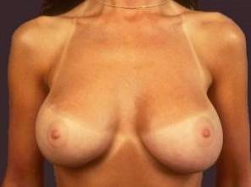 Aesthetic Breast Revision Before & After Gallery - Patient 419958 - Image 2