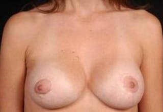 Aesthetic Breast Revision Before & After Gallery - Patient 426259 - Image 2