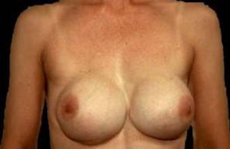 Aesthetic Breast Revision Before & After Gallery - Patient 149005 - Image 1