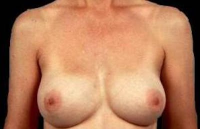 Aesthetic Breast Revision Before & After Gallery - Patient 149005 - Image 2