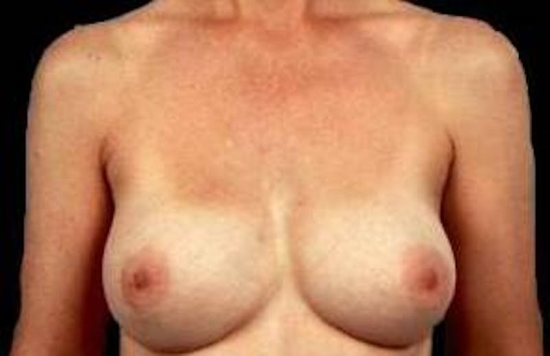 Aesthetic Breast Revision Before & After Gallery - Patient 149005 - Image 2