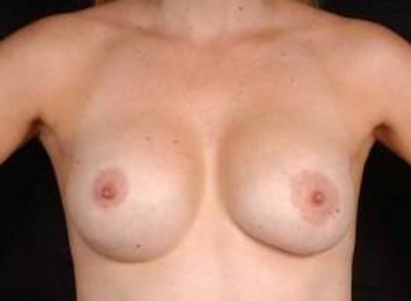 Aesthetic Breast Revision Before & After Gallery - Patient 939943 - Image 1