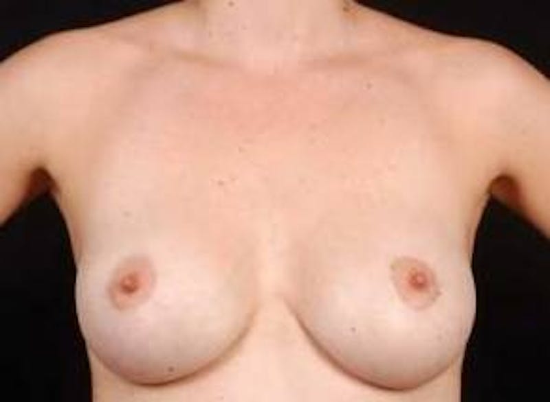 Aesthetic Breast Revision Before & After Gallery - Patient 939943 - Image 2