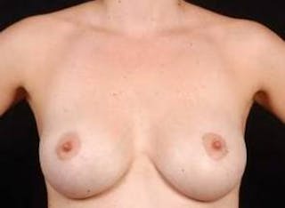 Aesthetic Breast Revision Before & After Gallery - Patient 939943 - Image 2