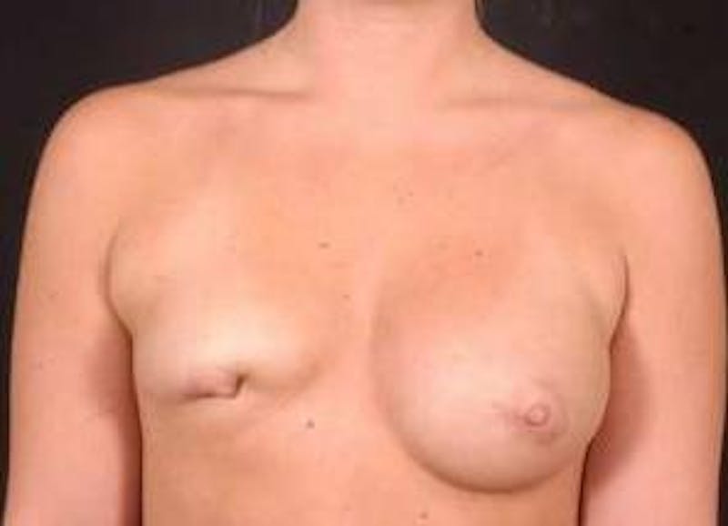 Aesthetic Breast Revision Before & After Gallery - Patient 105619 - Image 1