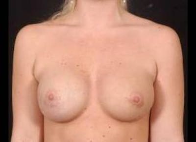 Aesthetic Breast Revision Before & After Gallery - Patient 105619 - Image 2