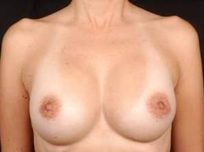 Aesthetic Breast Revision Before & After Gallery - Patient 119307 - Image 2