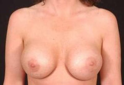 Aesthetic Breast Revision Before & After Gallery - Patient 291926 - Image 1