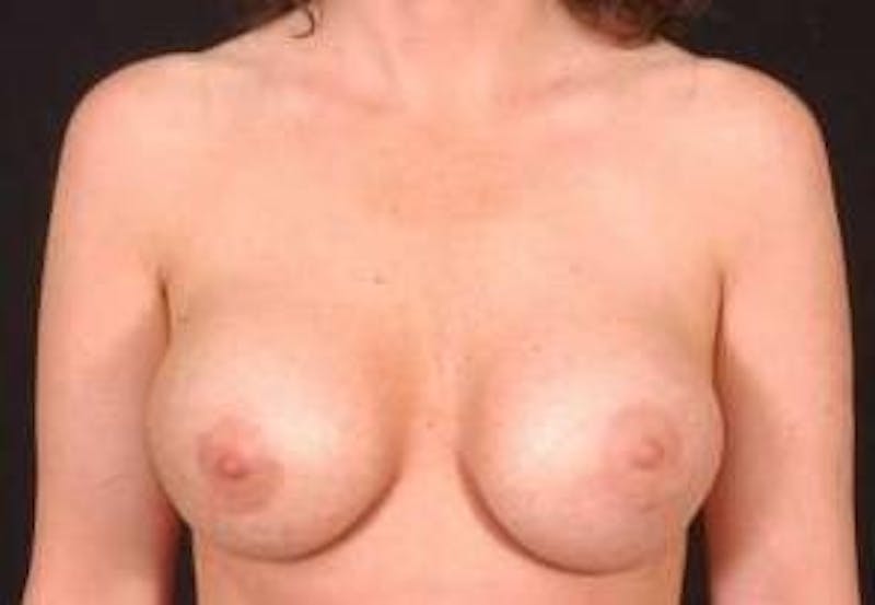 Aesthetic Breast Revision Before & After Gallery - Patient 291926 - Image 1