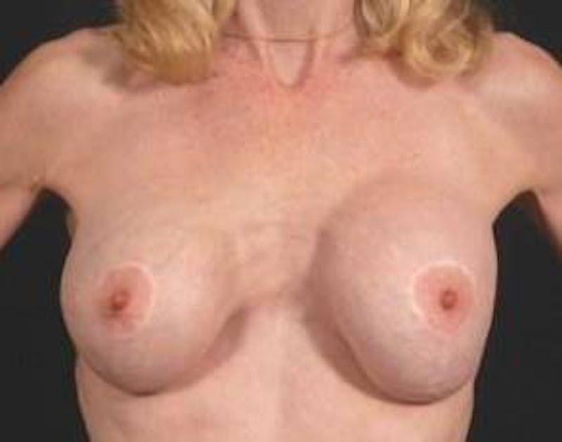 Aesthetic Breast Revision Before & After Gallery - Patient 350026 - Image 1