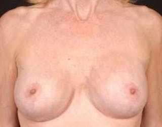Aesthetic Breast Revision Before & After Gallery - Patient 350026 - Image 2