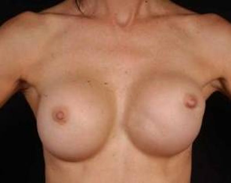 Aesthetic Breast Revision Before & After Gallery - Patient 418118 - Image 1