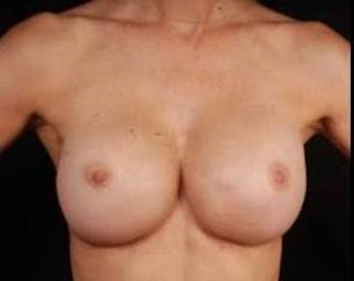 Aesthetic Breast Revision Before & After Gallery - Patient 418118 - Image 2