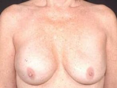 Aesthetic Breast Revision Before & After Gallery - Patient 161893 - Image 1