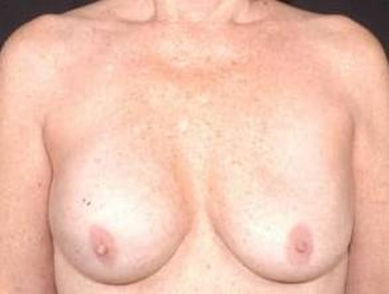 Aesthetic Breast Revision Before & After Gallery - Patient 161893 - Image 1