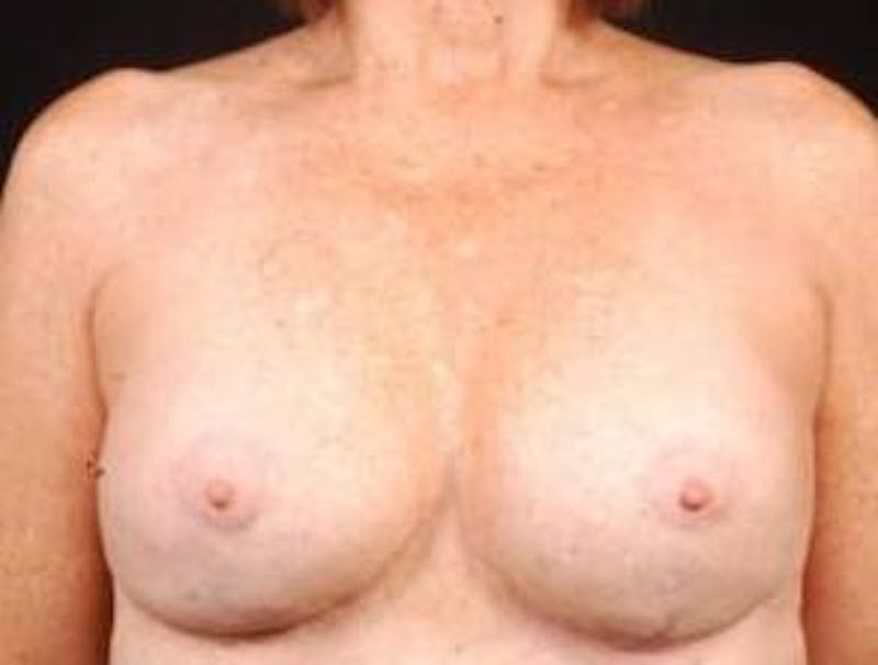 Aesthetic Breast Revision Before & After Gallery - Patient 161893 - Image 2