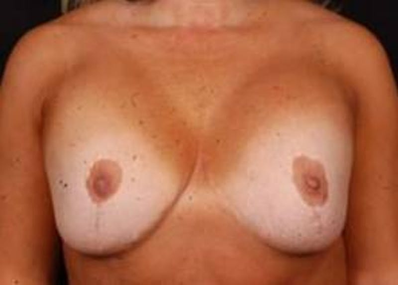Aesthetic Breast Revision Before & After Gallery - Patient 257066 - Image 1