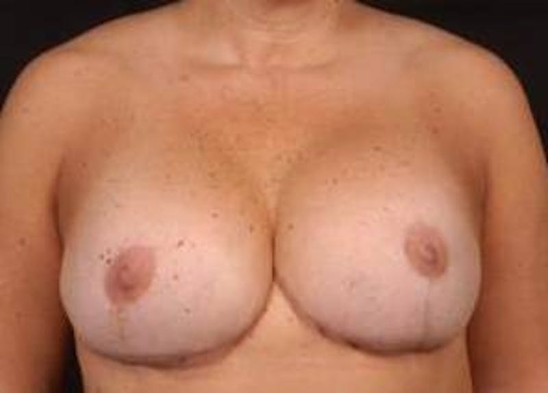 Aesthetic Breast Revision Before & After Gallery - Patient 257066 - Image 2