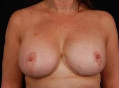 Aesthetic Breast Revision Before & After Gallery - Patient 210906 - Image 2
