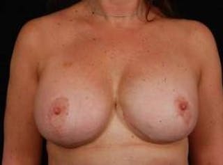 Aesthetic Breast Revision Before & After Gallery - Patient 210906 - Image 2