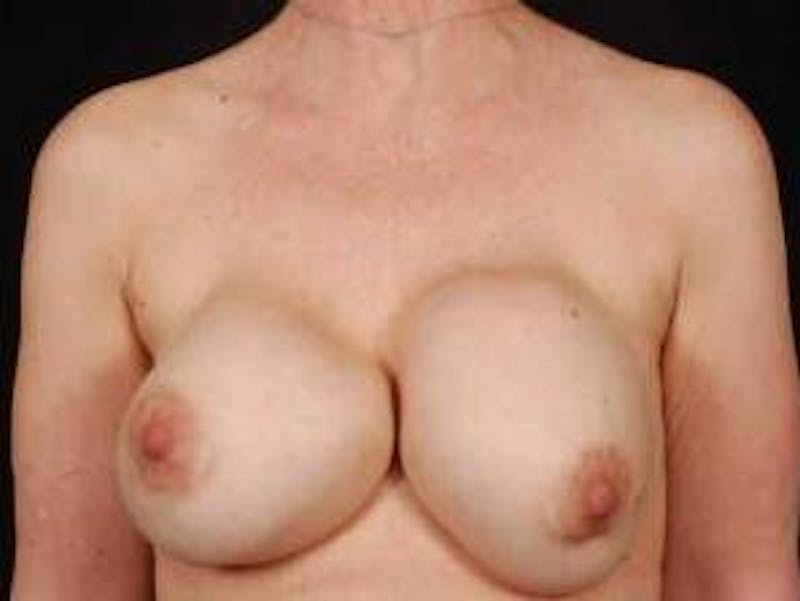 Aesthetic Breast Revision Before & After Gallery - Patient 199012 - Image 1