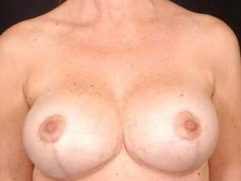 Aesthetic Breast Revision Before & After Gallery - Patient 199012 - Image 2