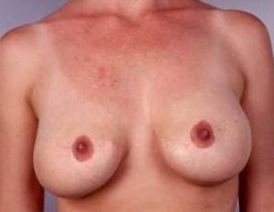 Aesthetic Breast Revision Before & After Gallery - Patient 178314 - Image 1