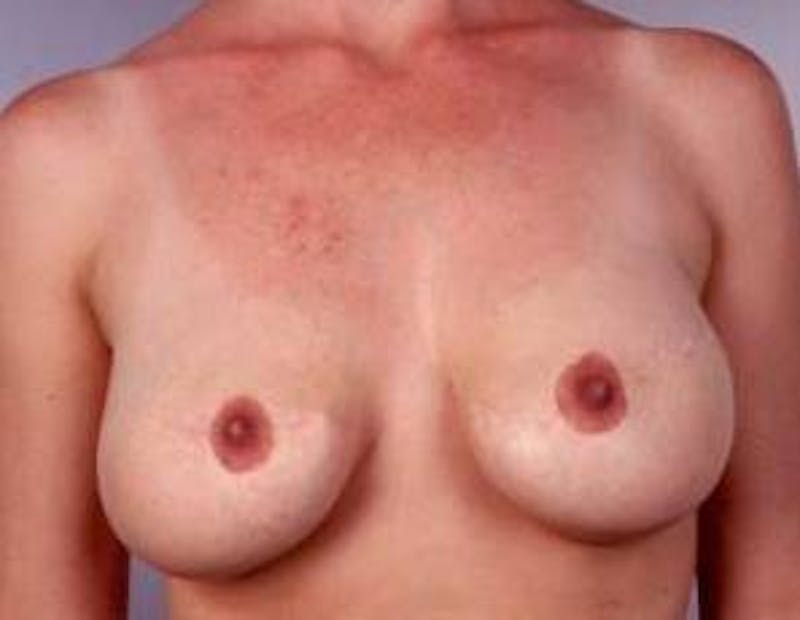 Aesthetic Breast Revision Before & After Gallery - Patient 178314 - Image 1