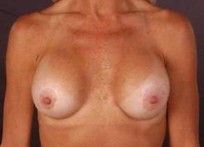 Aesthetic Breast Revision Before & After Gallery - Patient 245632 - Image 1