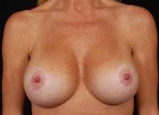 Aesthetic Breast Revision Before & After Gallery - Patient 245632 - Image 2