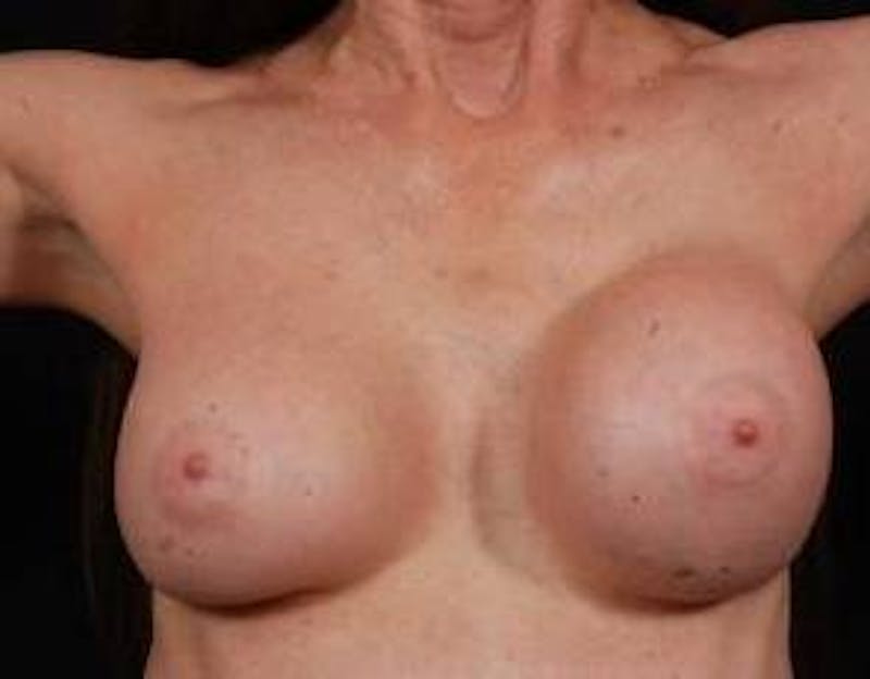 Aesthetic Breast Revision Before & After Gallery - Patient 288632 - Image 1