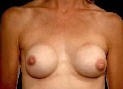 Aesthetic Breast Revision Before & After Gallery - Patient 180780 - Image 1