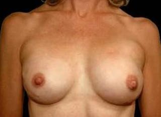 Aesthetic Breast Revision Before & After Gallery - Patient 180780 - Image 2