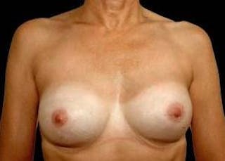 Aesthetic Breast Revision Before & After Gallery - Patient 344700 - Image 2