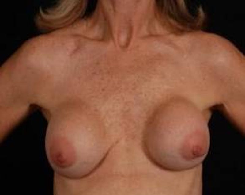 Aesthetic Breast Revision Before & After Gallery - Patient 188938 - Image 1