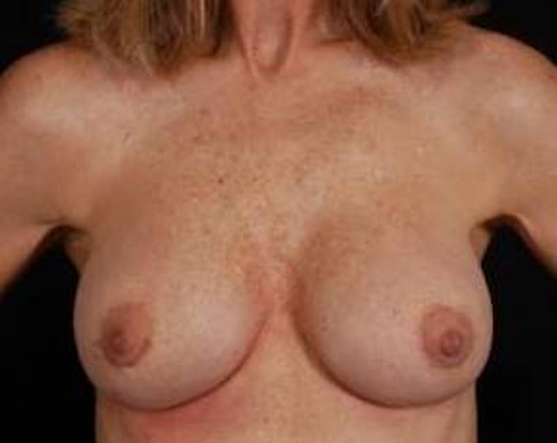 Aesthetic Breast Revision Before & After Gallery - Patient 188938 - Image 2