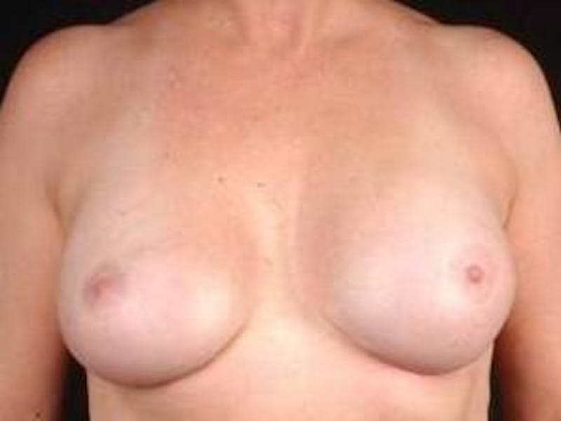 Aesthetic Breast Revision Before & After Gallery - Patient 169700 - Image 2
