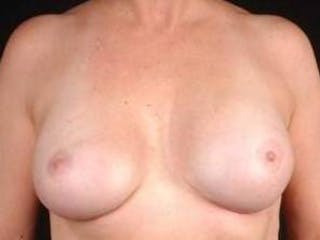 Aesthetic Breast Revision Before & After Gallery - Patient 169700 - Image 2