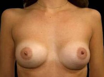 Aesthetic Breast Revision Before & After Gallery - Patient 495005 - Image 2