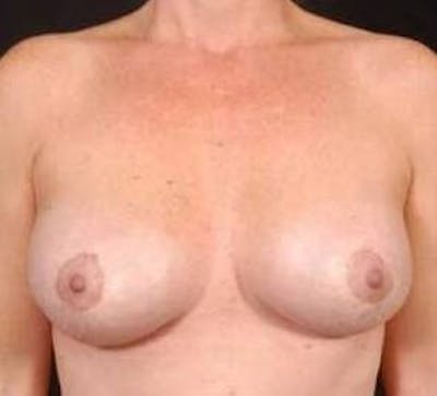 Aesthetic Breast Revision Before & After Gallery - Patient 116019 - Image 2