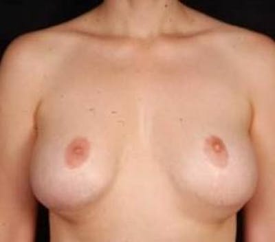 Aesthetic Breast Revision Before & After Gallery - Patient 101809 - Image 1