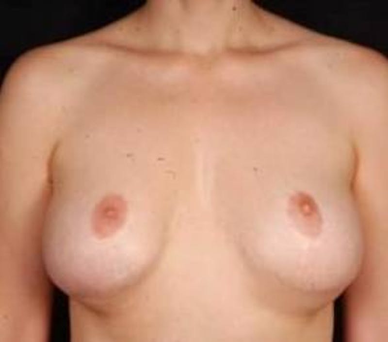 Aesthetic Breast Revision Before & After Gallery - Patient 101809 - Image 1